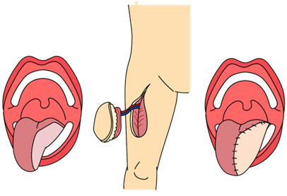 前外側大腿皮弁の説明イラスト