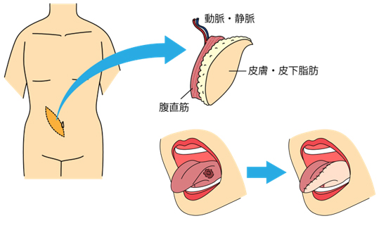 腹直筋皮弁の説明イラスト