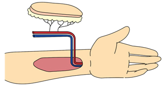 前腕皮弁の説明イラスト