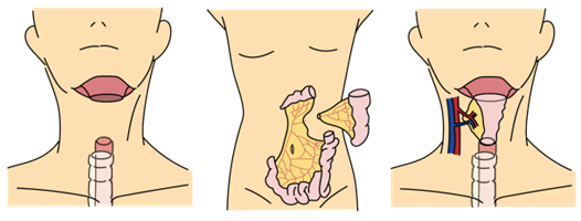 空腸移植の説明イラスト
