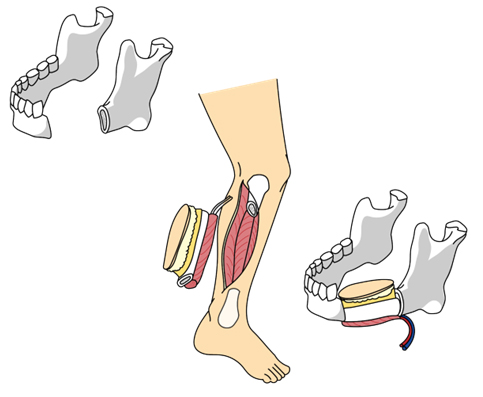 腓骨皮弁の説明イラスト