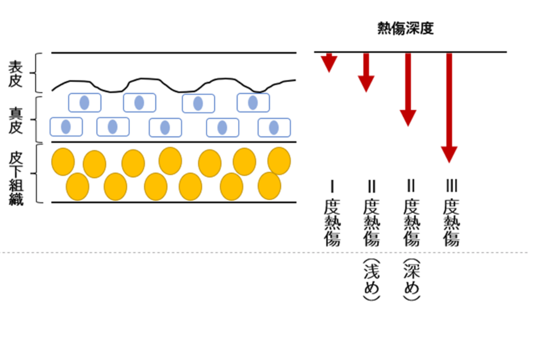 熱傷の分類