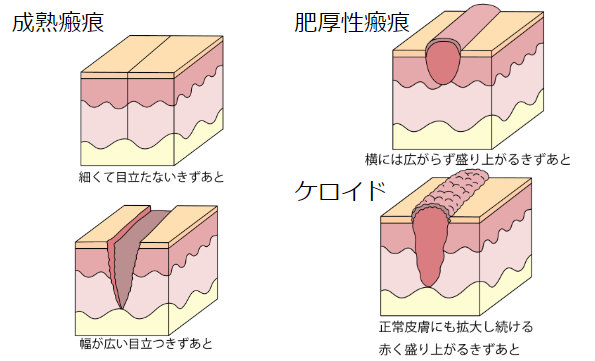 肥厚性瘢痕・ケロイド①