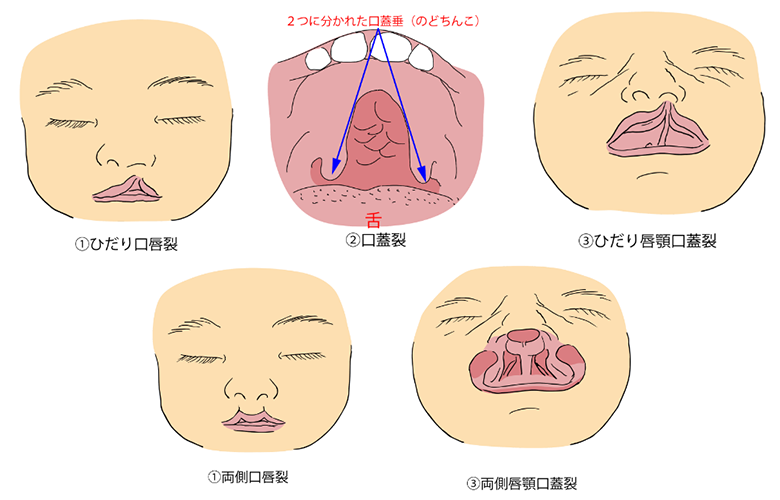 口唇口蓋裂のイラスト