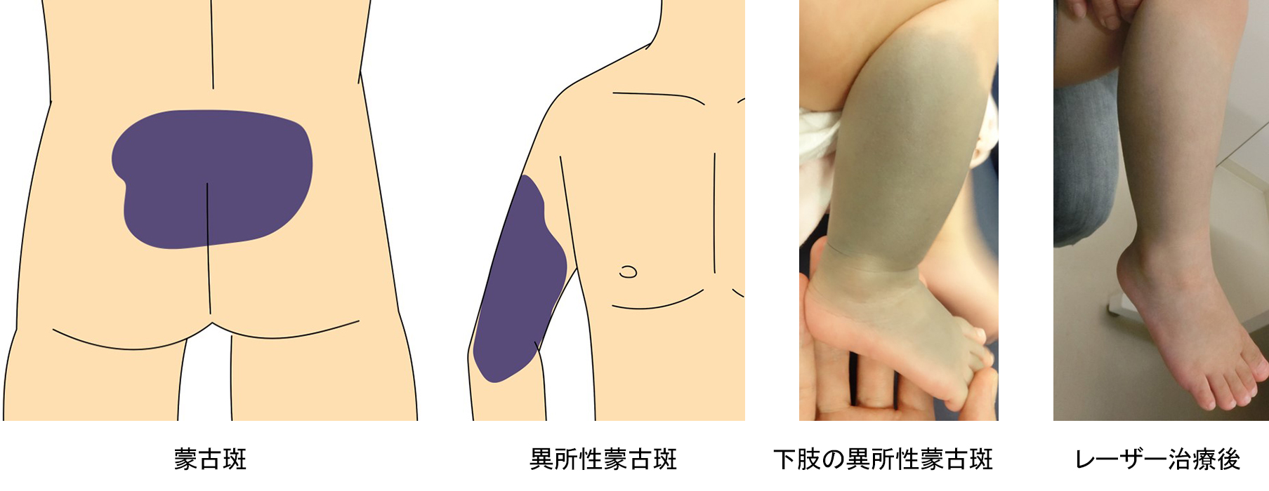 蒙古斑　異所性蒙古斑　下肢の異所性蒙古斑　レーザー治療後