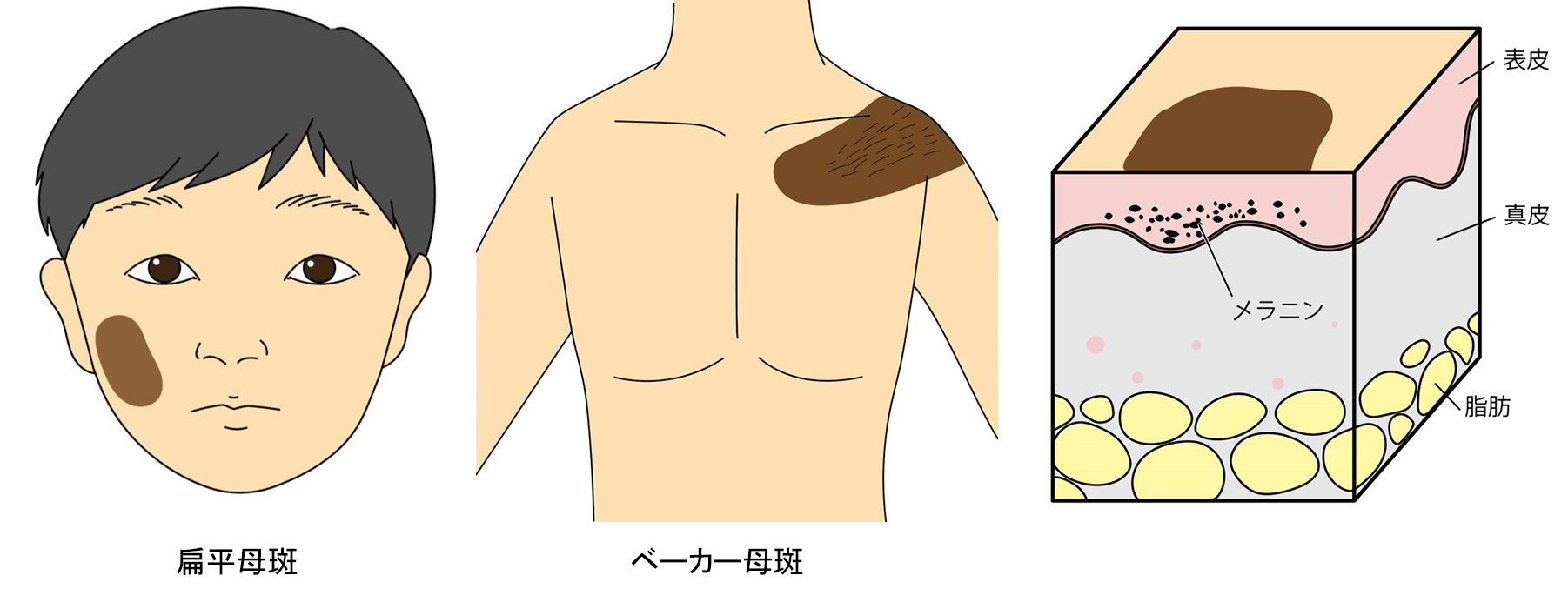 扁平母斑　ベーカー母斑