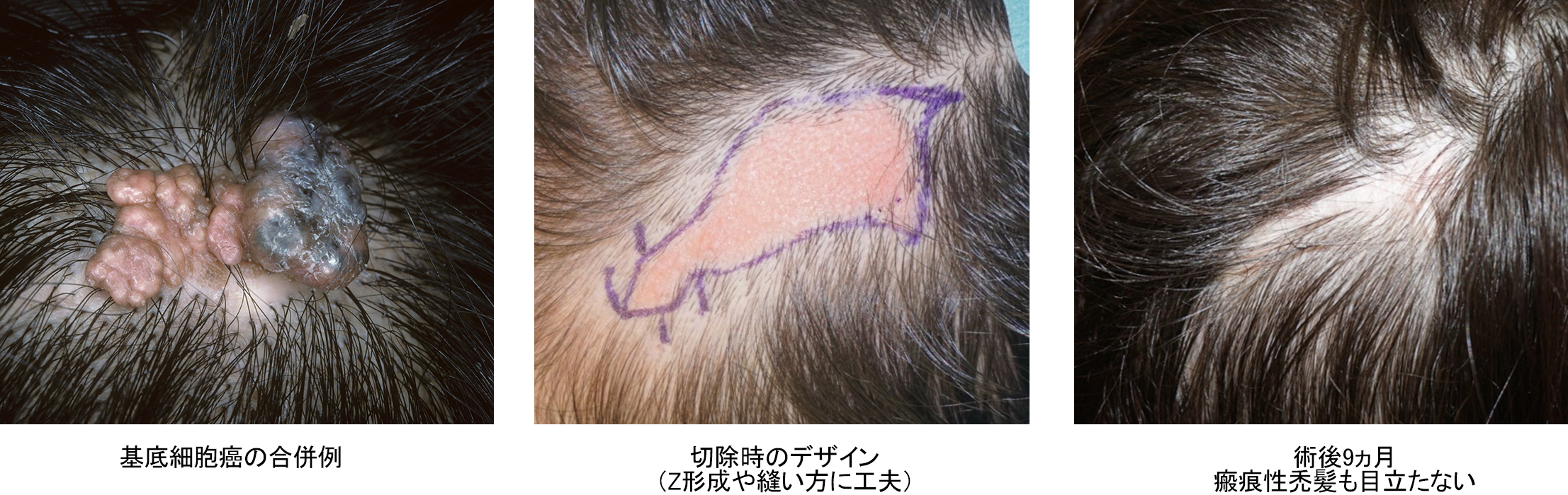 基底細胞癌の合併例　切除時のデザイン（Z形成や縫い方に工夫）　術後9ヵ月　瘢痕性禿髪も目立たない
