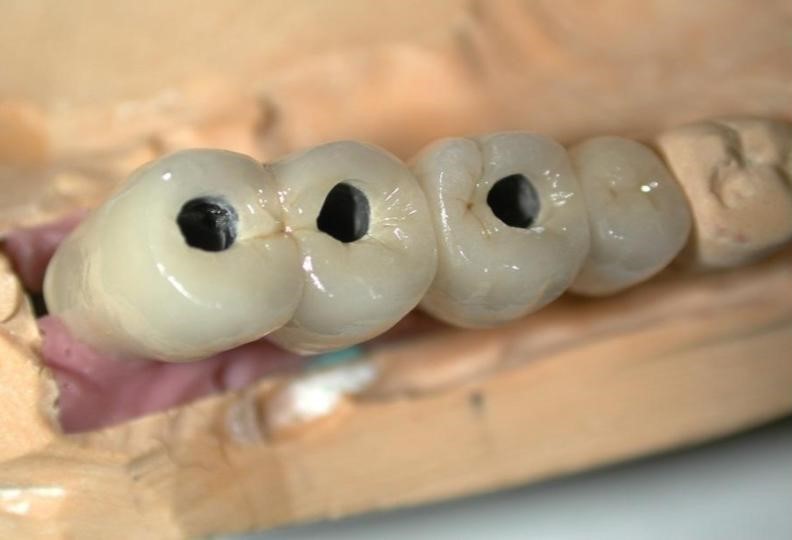 インプラント上に人工歯を装着する画像①