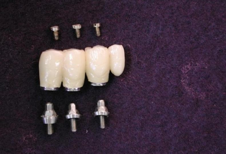 インプラント上に人工歯を装着する画像④