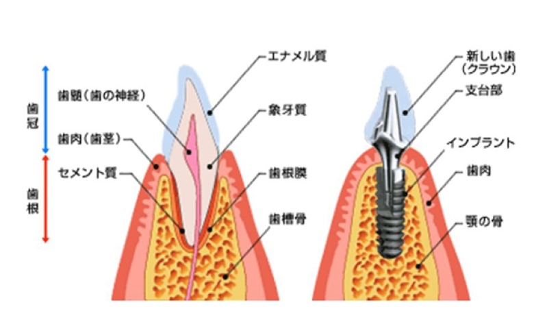 インプラント説明図②