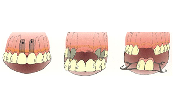 インプラント説明図①