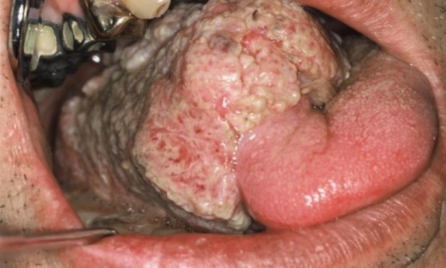 舌癌の様子