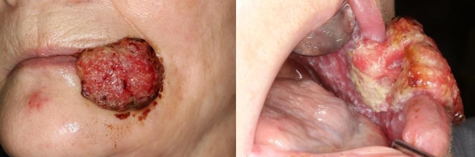 頬粘膜癌（扁平上皮癌：ステージⅣ）治療前の様子