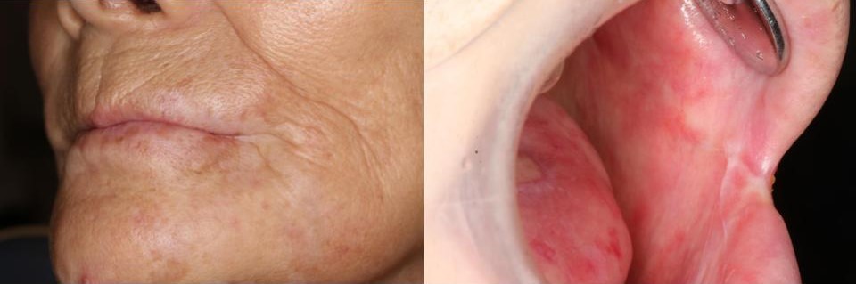 頬粘膜癌（扁平上皮癌：ステージⅣ）治療後7か月の様子