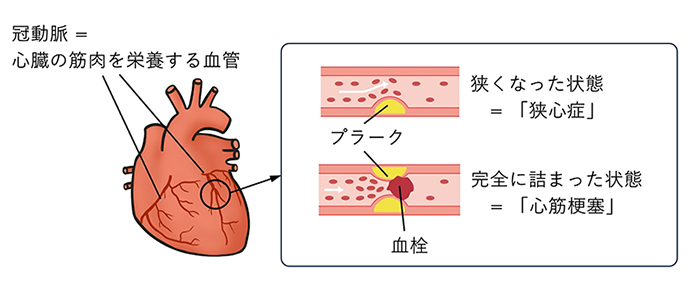 冠動脈が描かれた心臓のイラストと、狭心症と心筋梗塞になった冠動脈の拡大図