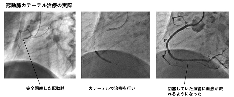 虚血性心疾患治療の写真