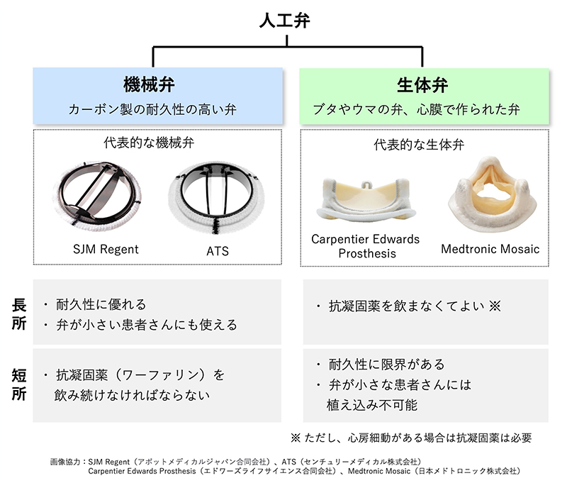 機械弁と生体弁の長所と短所を示した図