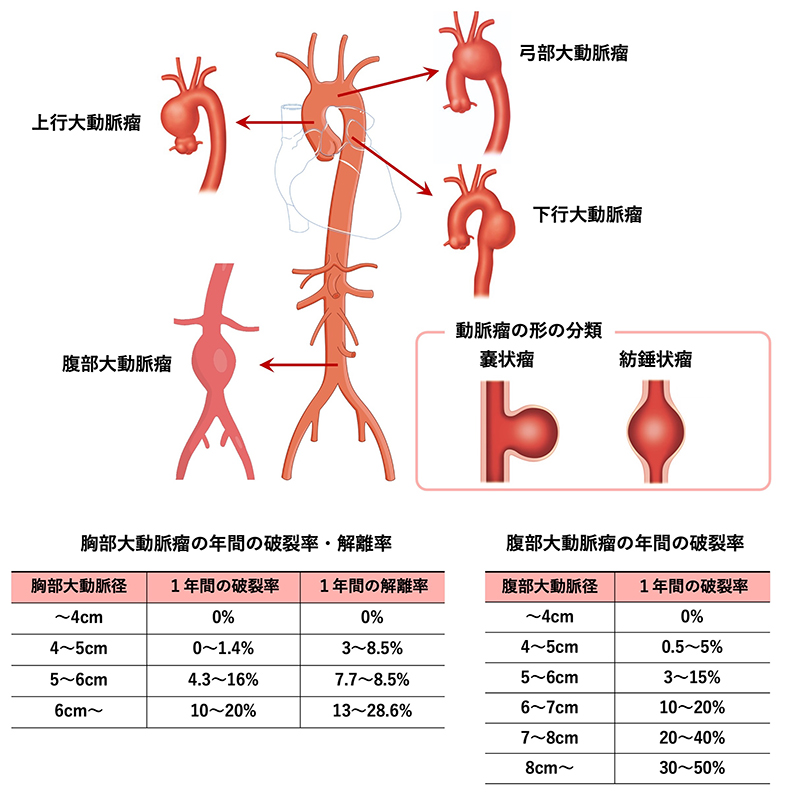 大動脈瘤の種類と分類を示した図