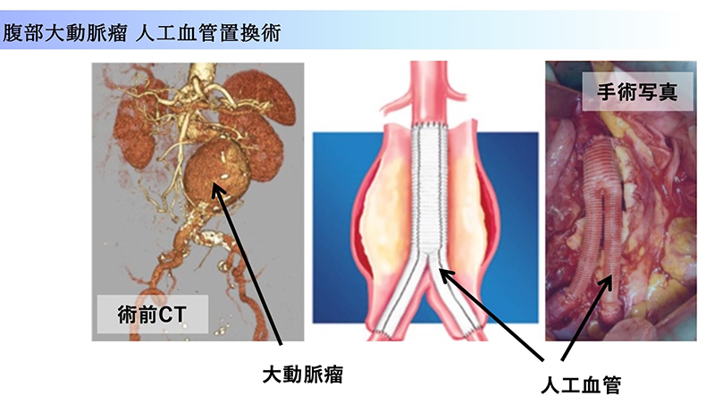 腹部大動脈瘤人工血管置換術の術前CTと手術写真