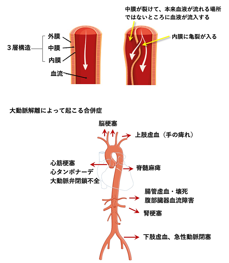 大動脈解離の仕組みと合併症を示した図
