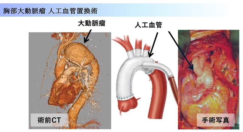 大動脈瘤人工血管置換術の術前CTと手術写真