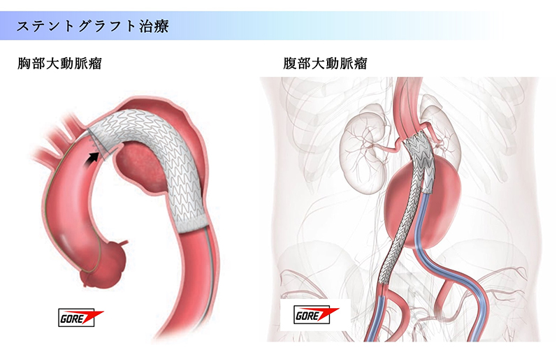 手作りステントグラフト治療のCG画像