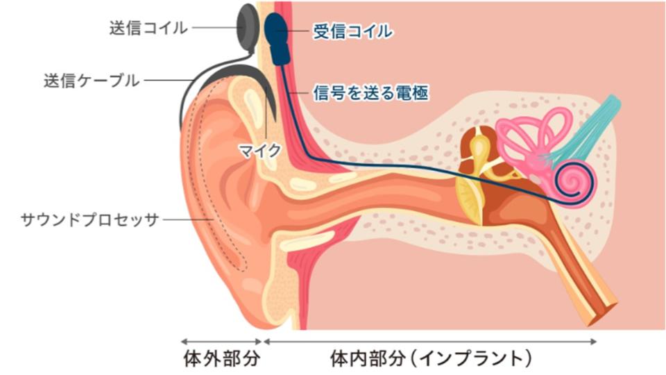 人工内耳の簡単な仕組みの図