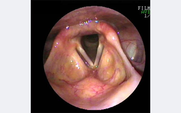 喉頭ファイバースコピーの画像