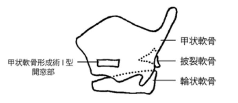 甲状軟骨形成術I型、披裂軟骨内転術の範囲
