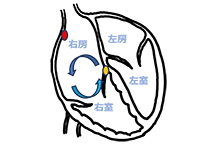 房室結節回帰性頻拍の説明図