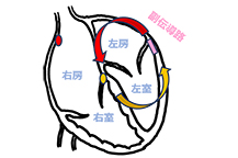 WPW症候群の説明図