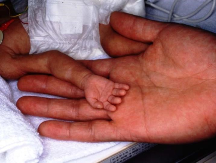 早産児と大人の手の写真