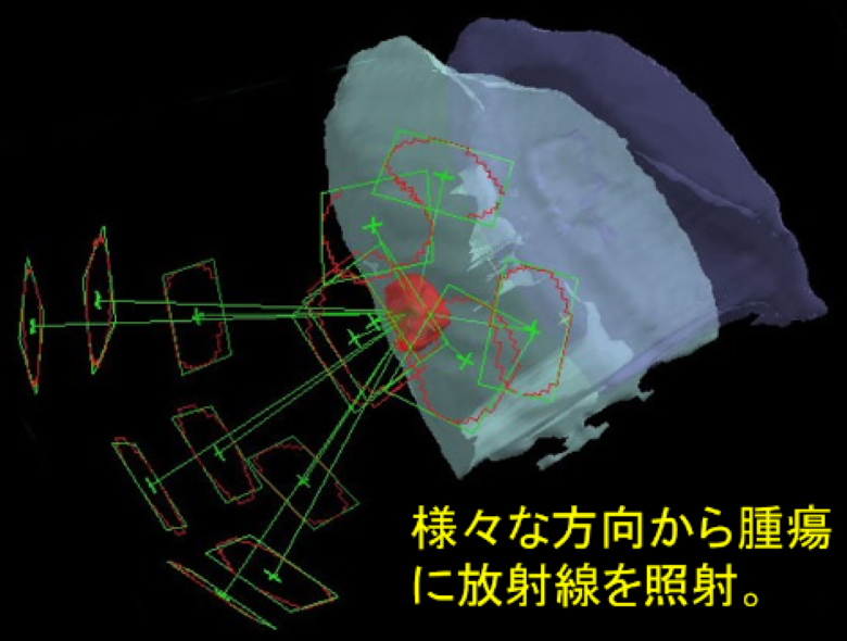 定位放射線照射①