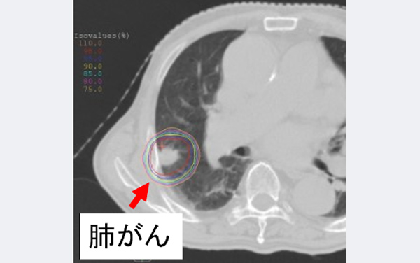 定位放射線照射②