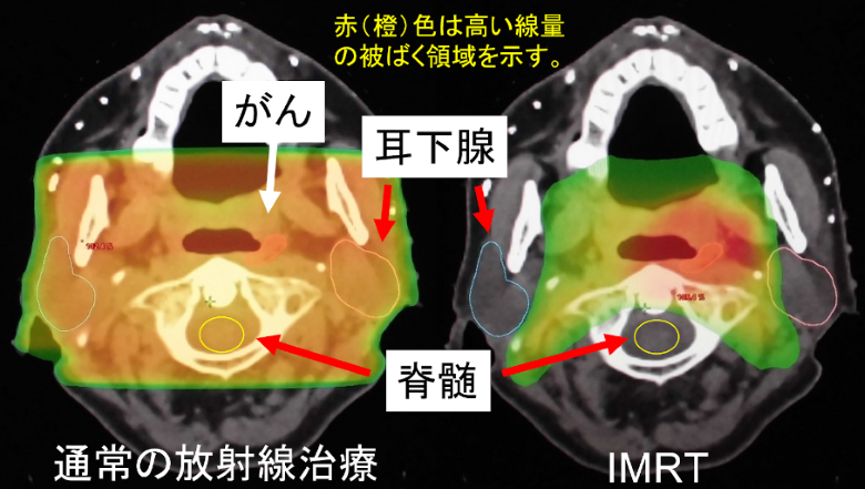 通常の照射とIMRTの線量分布の違い