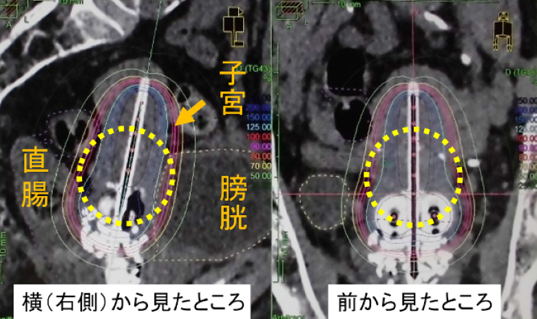 最新の画像誘導技術を使用した画像誘導小線源治療