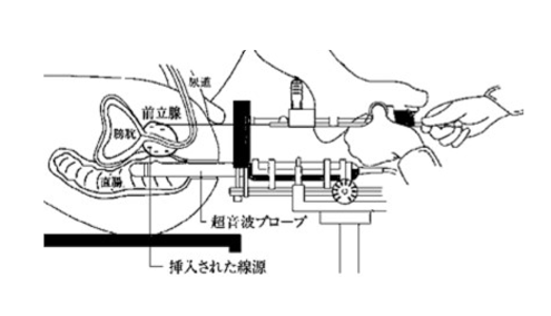 密封小線源永久挿入療法②