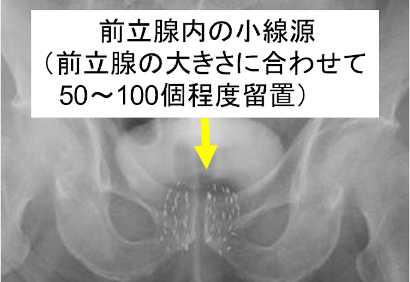 密封小線源永久挿入療法③