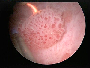 膀胱鏡にて認められた膀胱腫瘍の画像