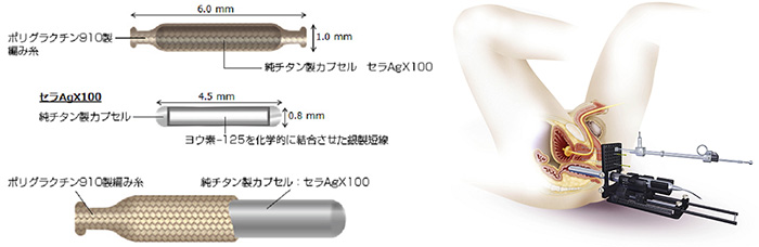 小線源治療で使用する器具と前立腺に器具をはめ込むイメージ画像