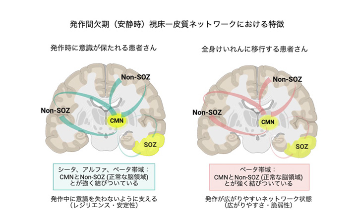 てんかん発作時の意識障害に関わる 視床-皮質ネットワークの特徴を発見