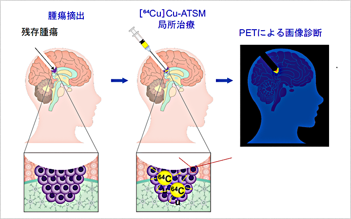 悪性脳腫瘍に対する“低酸素領域標的型”局所放射線治療の有効性を実証