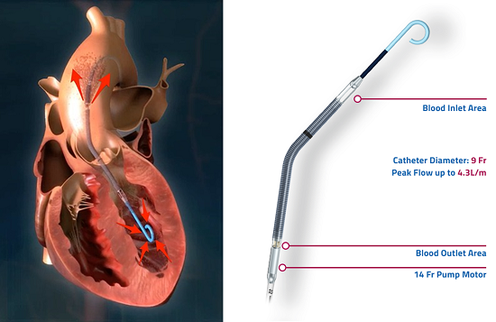 補助循環用ポンプカテーテル（IMPELLA）