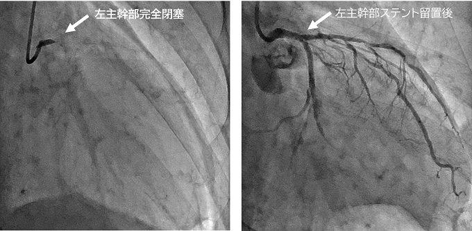 左：左主幹部完全閉塞、右：左主幹部ステント留置後