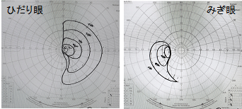 視野検査の図