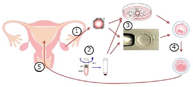 排卵誘発→採卵/採精→体外受精または顕微授精→胚培養→胚移植・胚凍結保存からなる一連の治療の図