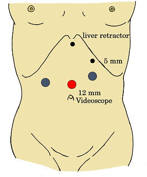 肥満外科におけるポート位置の図