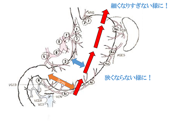 スリープ状胃切除術の図