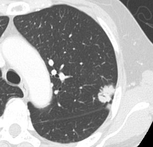 早期肺癌の一例の写真