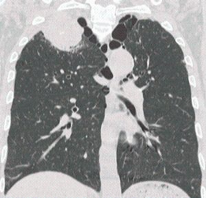 進行肺癌の一例の写真